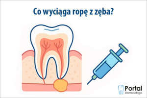 Co wyciąga ropę z zęba?