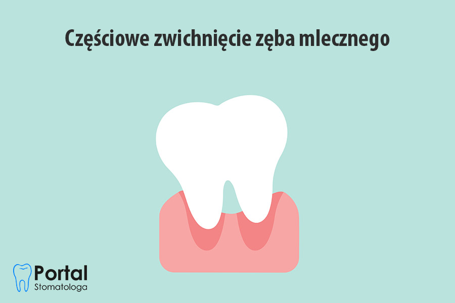 Częściowe zwichnięcie zęba mlecznego