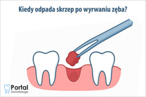 Kiedy odpada skrzep po wyrwaniu zęba?