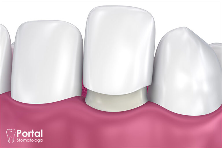 Licówki porcelanowe