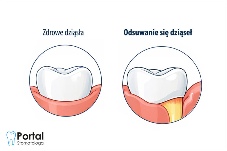 Odsuwanie się dziąseł