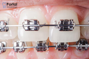 Repozycja ortodontyczna