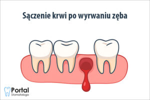 Sączenie krwi po wyrwaniu zęba