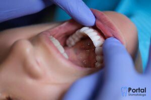 Licówki kompozytowe