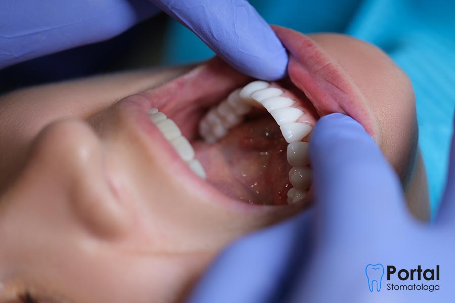 Licówki kompozytowe