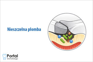 Nieszczelna plomba