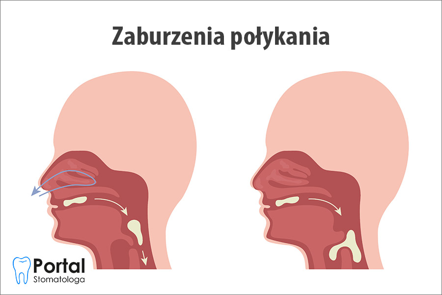 Zaburzenia połykania