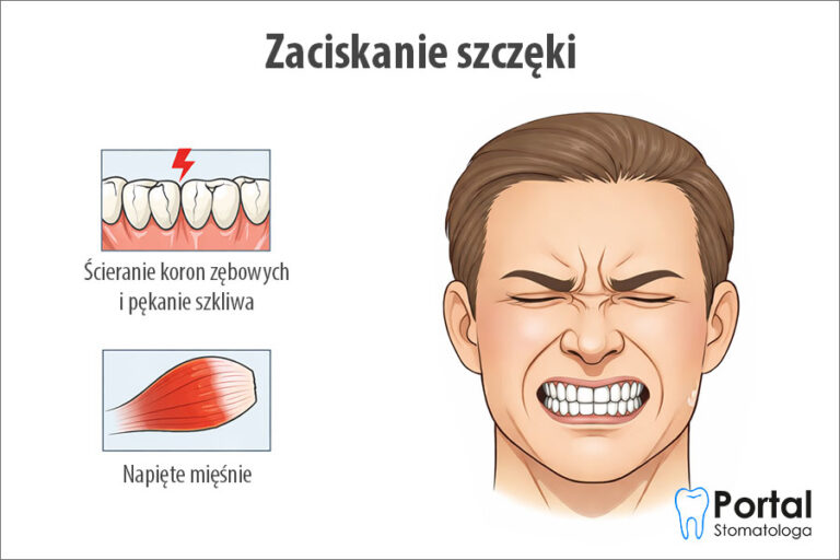 Zaciskanie szczęki