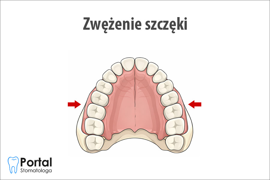 Zwężenie szczęki