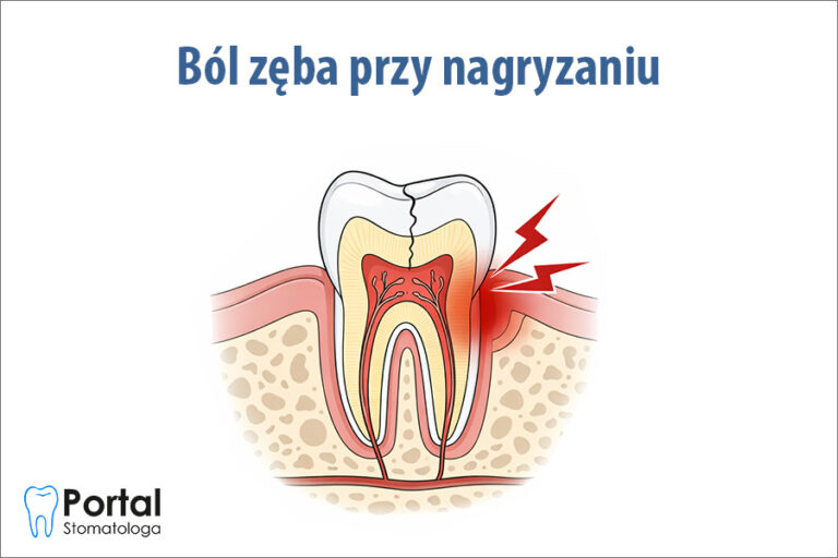 Ból zęba przy nagryzaniu