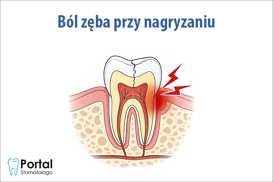 Ból zęba przy nagryzaniu