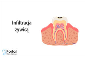 Infiltracja żywicą
