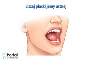 Liszaj płaski jamy ustnej