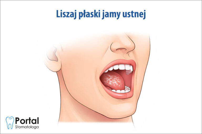 Liszaj płaski jamy ustnej
