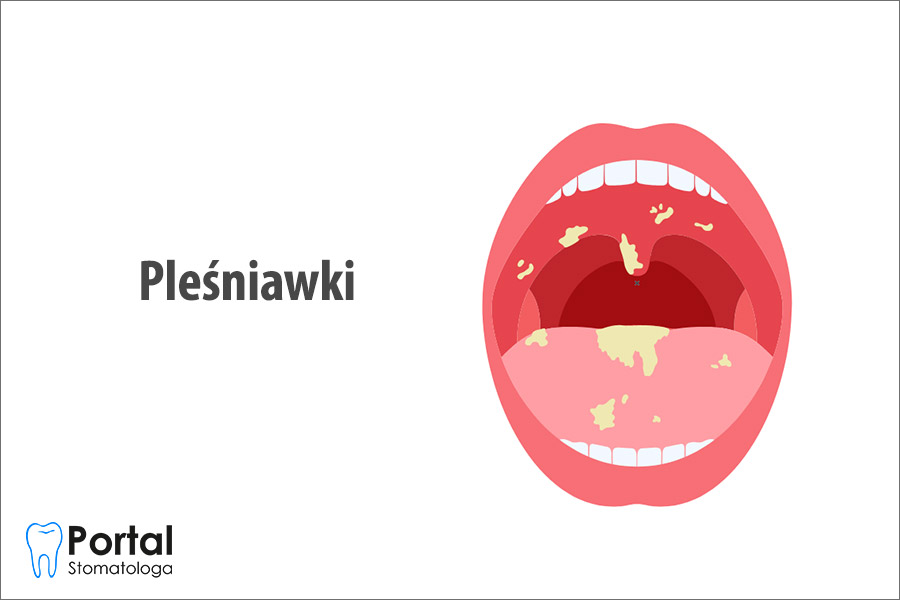 Pleśniawki
