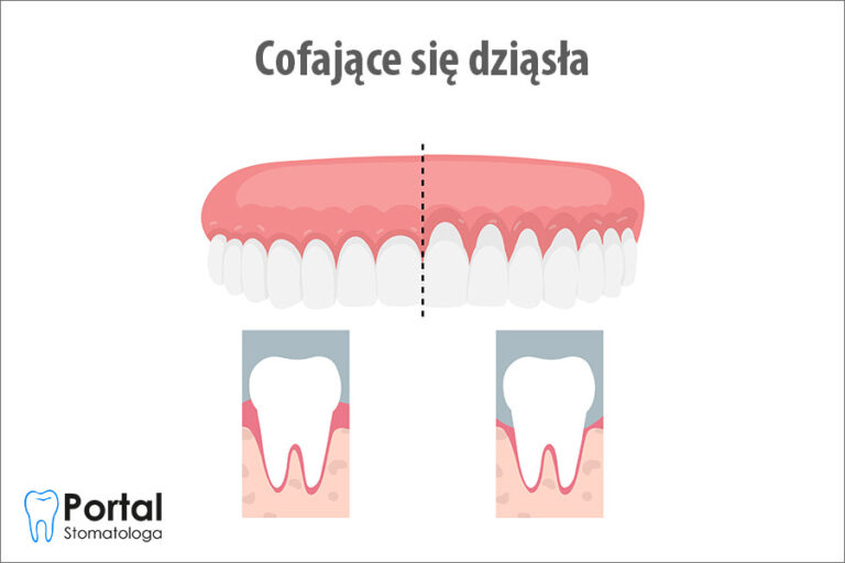 Cofające się dziąsła