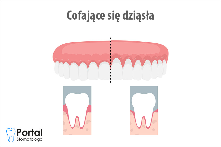 Cofające się dziąsła