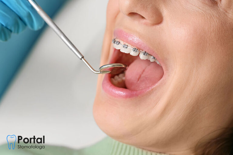 Czy warto zakładać aparat po 30?