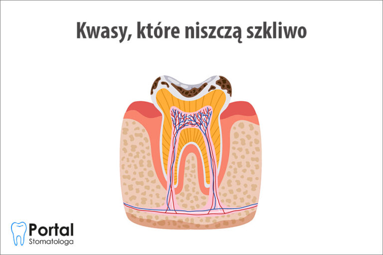 Kwasy, które niszczą szkliwo