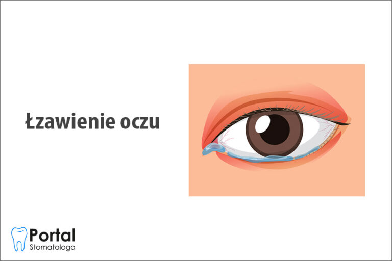 Łzawienie oczu