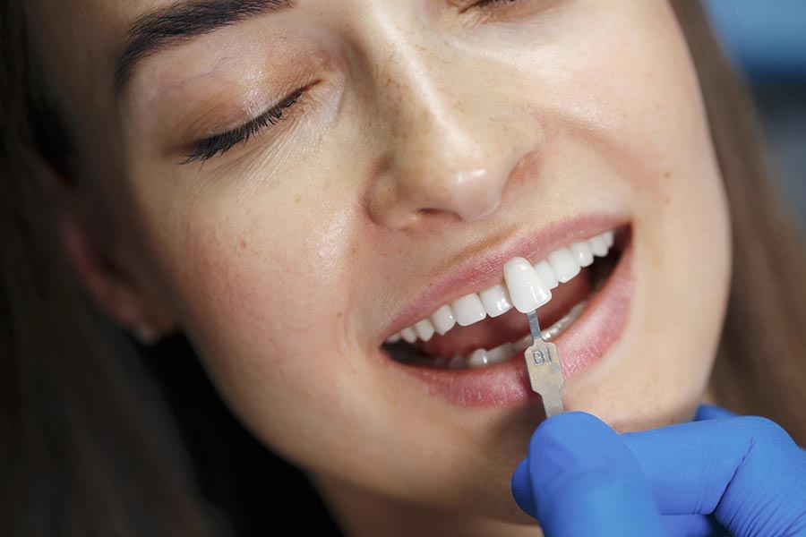 Naturalny efekt bez przesady – kiedy bonding jest lepszy niż licówki? Naturalny efekt bez przesady – kiedy bonding jest lepszy niż licówki?