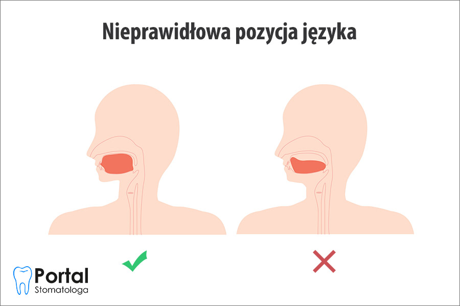 Nieprawidłowa pozycja języka