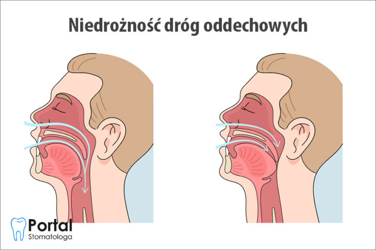 Niedrożność dróg oddechowych