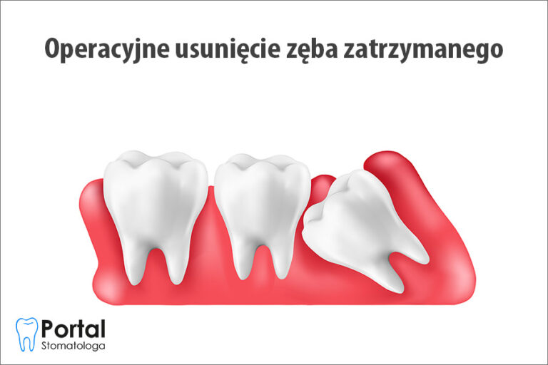 Operacyjne usunięcie zęba zatrzymanego