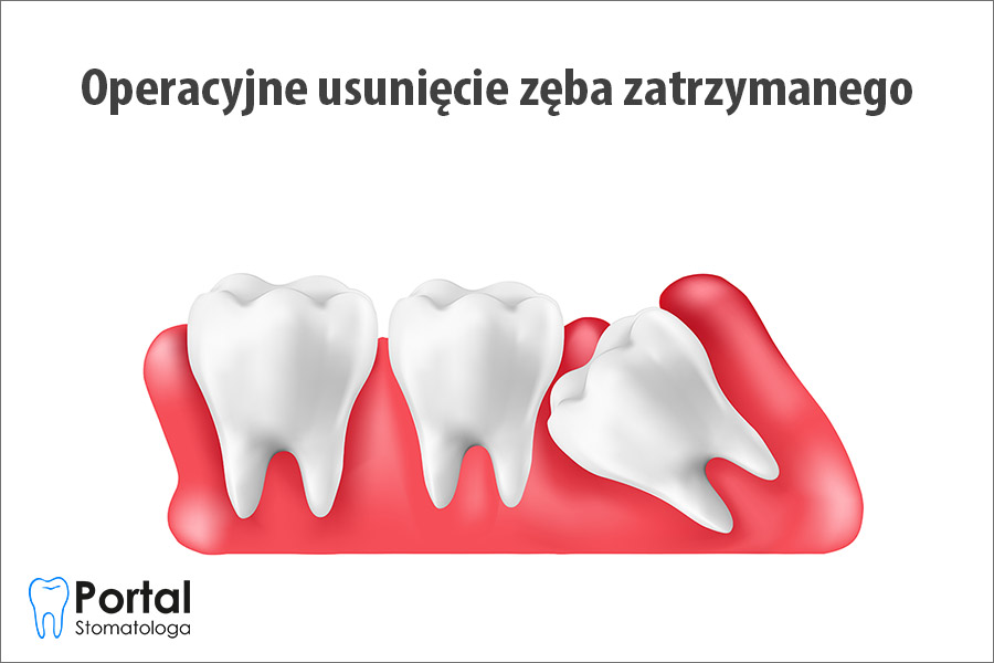 Operacyjne usunięcie zęba zatrzymanego