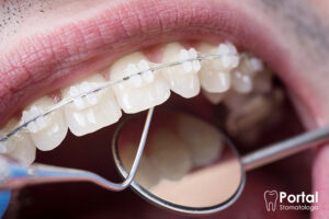 Aparat ortodontyczny dla dorosłych