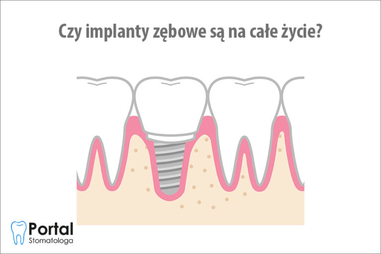 Czy implanty zębowe są na całe życie?