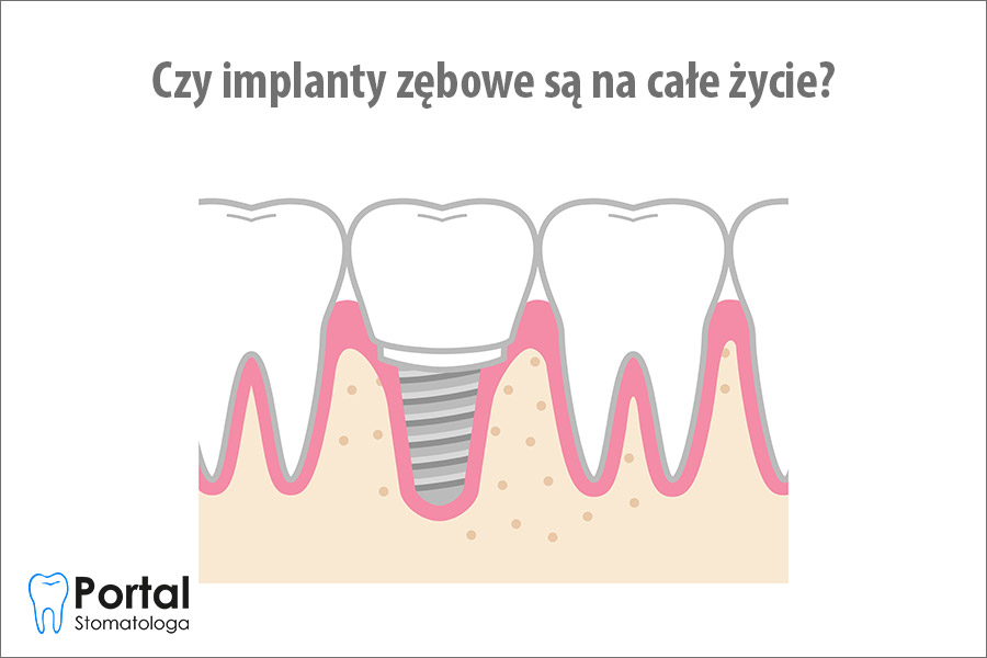 Czy implanty zębowe są na całe życie?