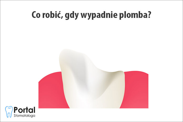 Co robić, gdy wypadnie plomba?