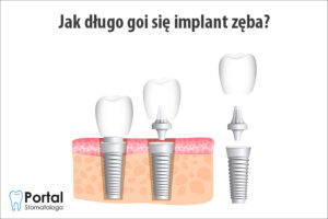 Jak długo goi się implant zęba?