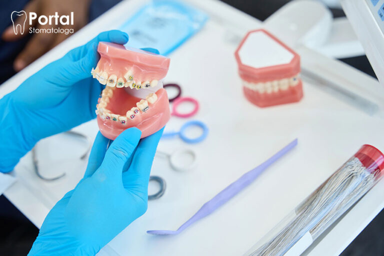 Jak długo nosi się aparat na zęby?