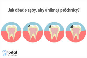 Jak dbać o zęby, aby uniknąć próchnicy?