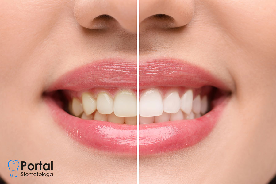 Jak długo utrzymuje się efekt wybielania zębów?