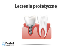 Leczenie protetyczne