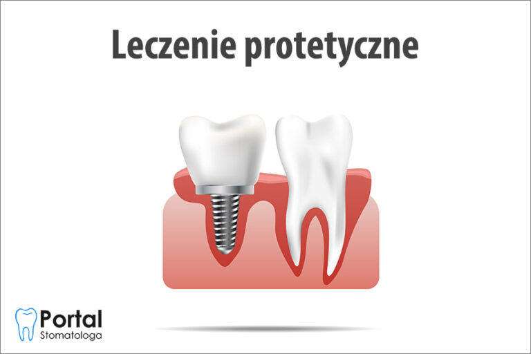 Leczenie protetyczne