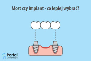 Most czy implant - co lepiej wybrać?