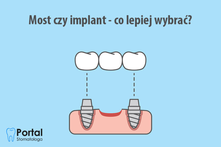 Most czy implant - co lepiej wybrać?