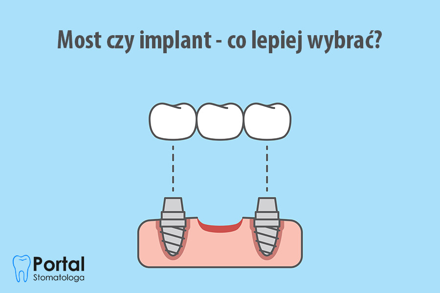 Most czy implant - co lepiej wybrać?