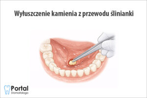 Wyłuszczenie kamienia z przewodu ślinianki