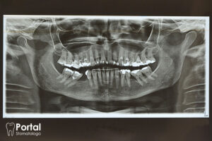 Zdjęcia pantomograficzne
