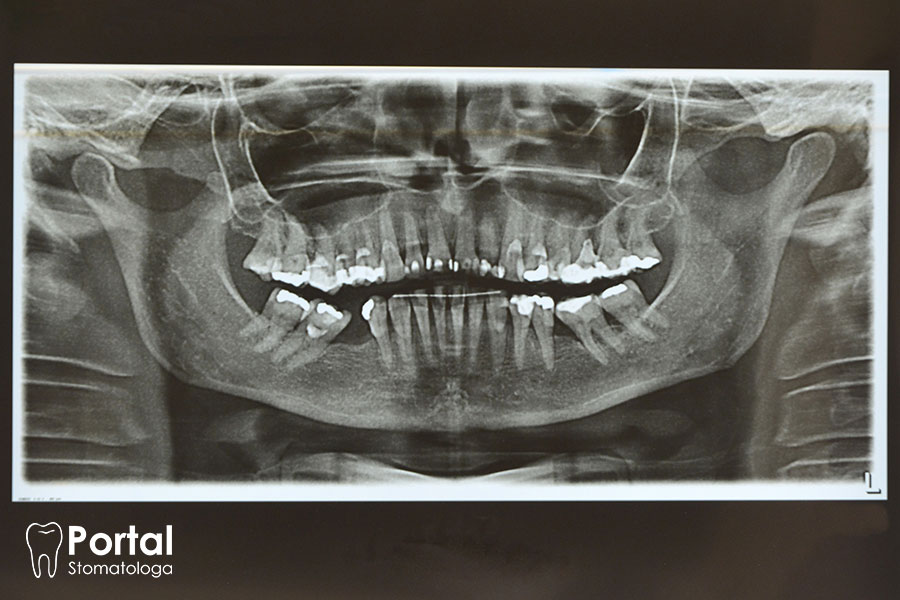 Zdjęcia pantomograficzne