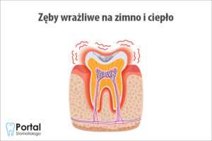 Zęby wrażliwe na zimno i ciepło