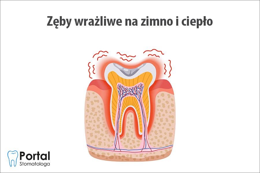 Zęby wrażliwe na zimno i ciepło