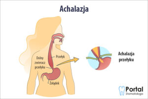 Achalazja