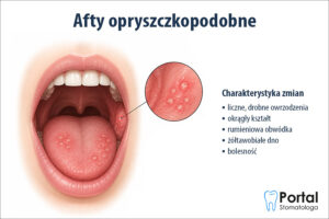 Afty opryszczkopodobne