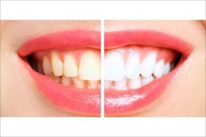 Jak uzyskać Hollywood Smile?